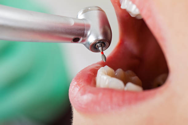 Best Emergency Wisdom Tooth Extraction in Soulsbyville, CA